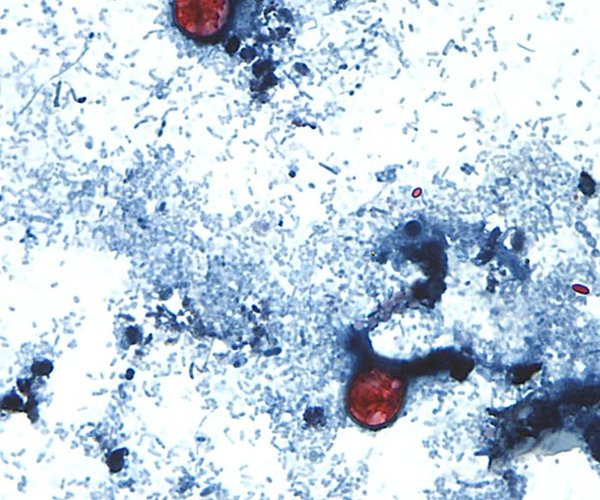 07142026 CYCLOSPORIASIS