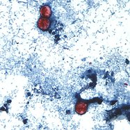 07142026 CYCLOSPORIASIS