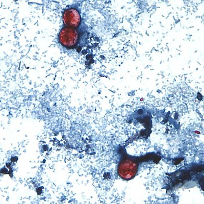 07142026 CYCLOSPORIASIS